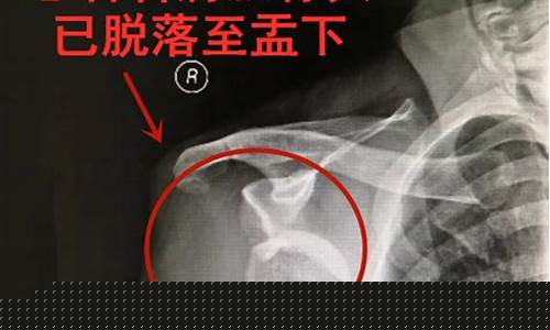 打篮球肩膀脱臼的处理-打篮球肩膀受伤怎么办